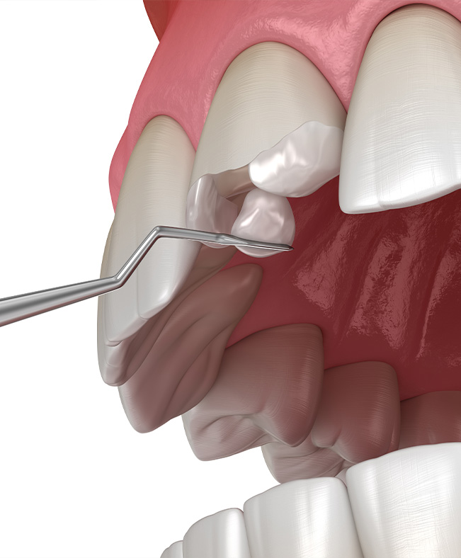 Broken Teeth